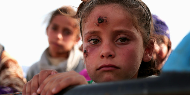 A girl, who according to her parents is showing symptoms of Leishmaniasis, returns with others to their town of Hisha, after the Syrian Democratic Forces (SDF) took control of the area from Islamic State militants, in the northern Raqqa countryside, Syria November 14, 2016. REUTERS/Rodi Said