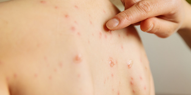 Mother taking care of a girl with chickenpox disease