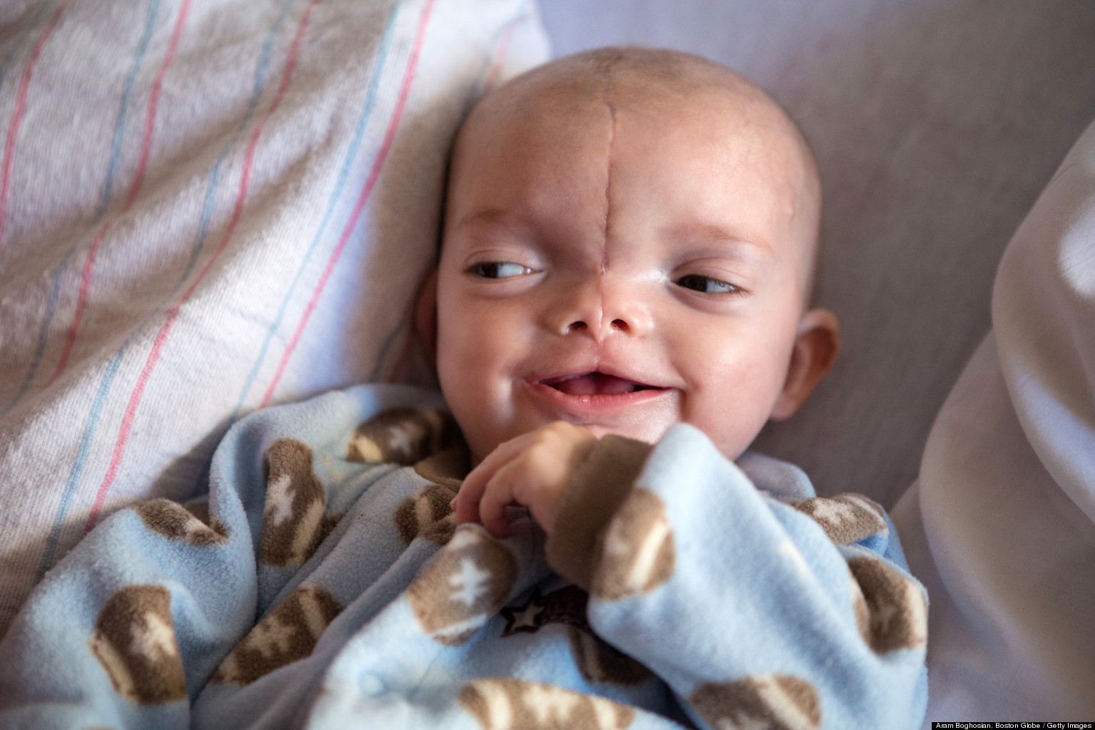 Dominic Pio Gundrum, Baby Born With Encephalocele And Tessier Facial