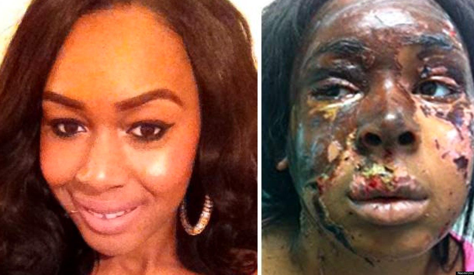 London Acid Attack: Naomi Oni Severely Burned, Partially Blind After